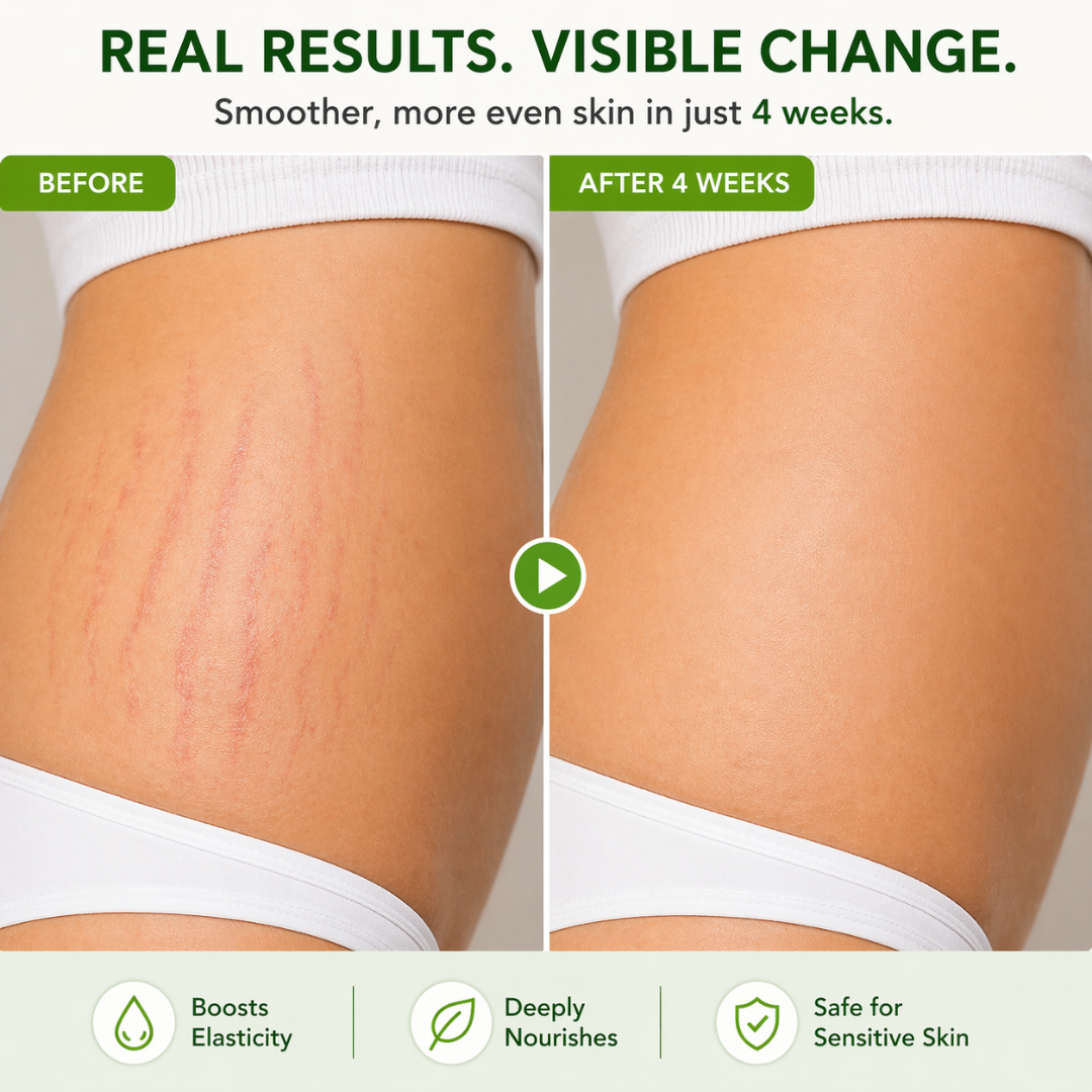 Stretch Marks Removal Oil – For New and Expecting mothers 100ml